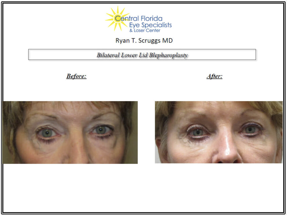 Lower Eyelid Blepharoplasty Before and After