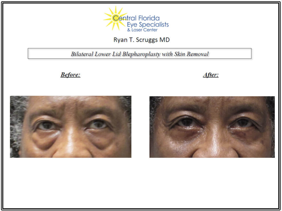 Lower Eyelid Blepharoplasty Before and After