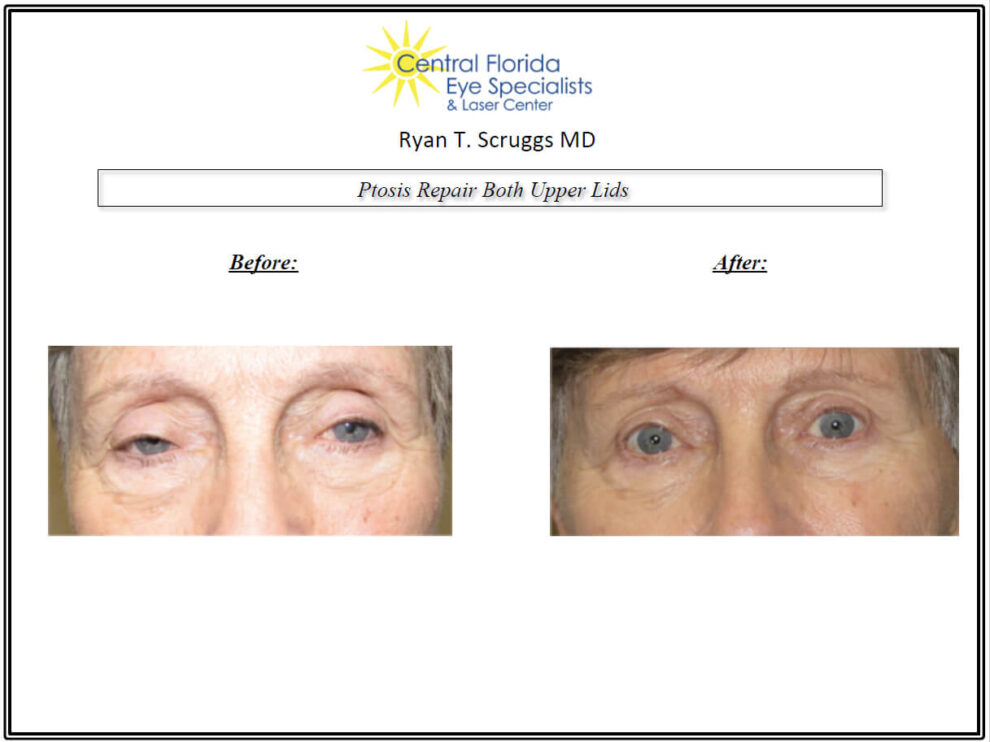 ptosis repair both before and after