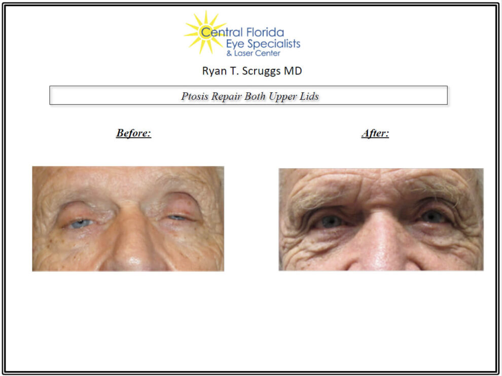 Ptosis Repair Before and After