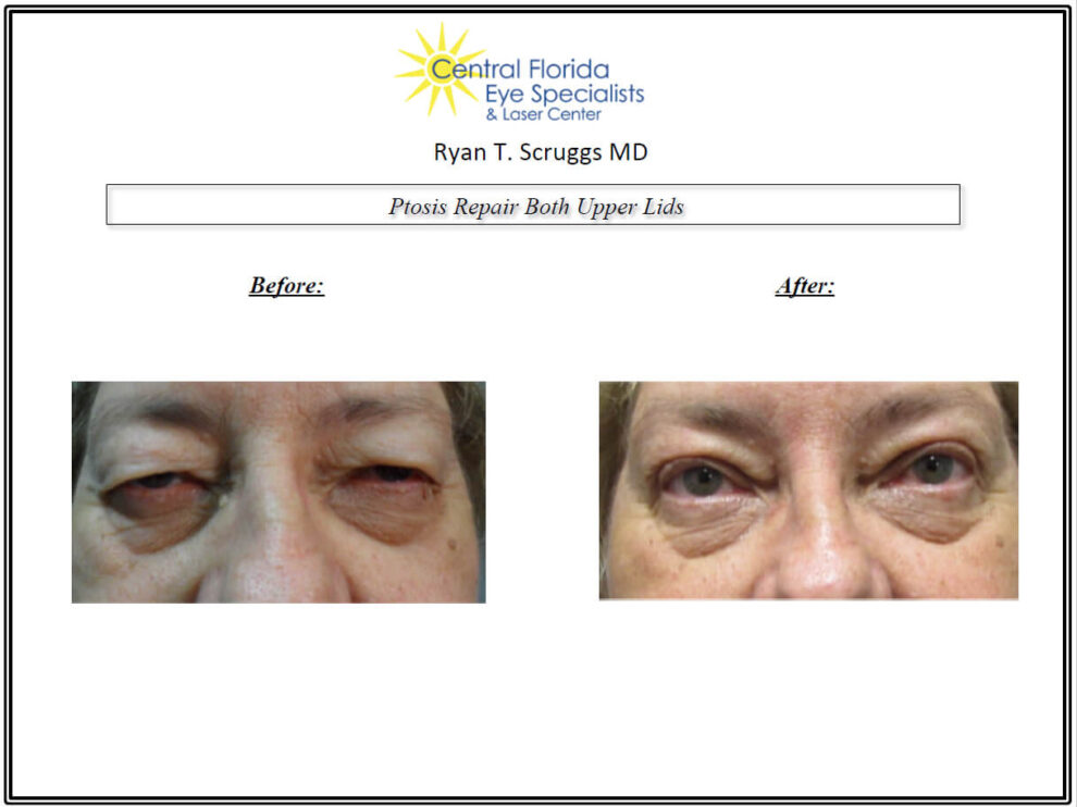 Ptosis Repair Before and After