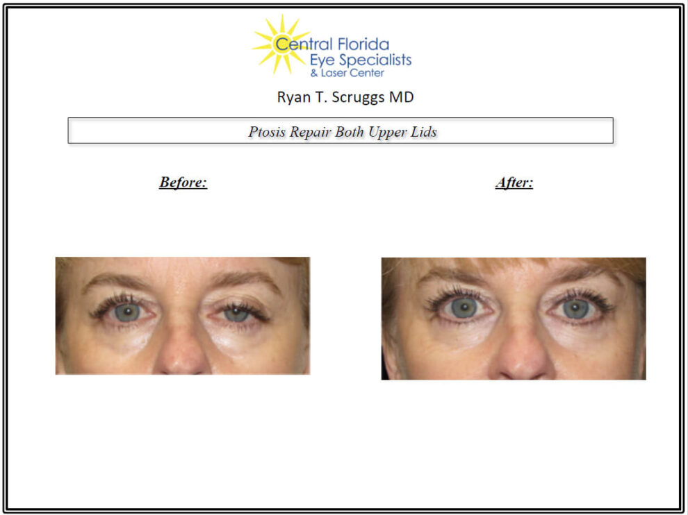 Ptosis Repair Before and After