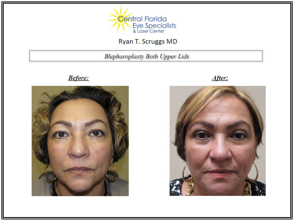 Blepharoplasty Upper Lids Before and After