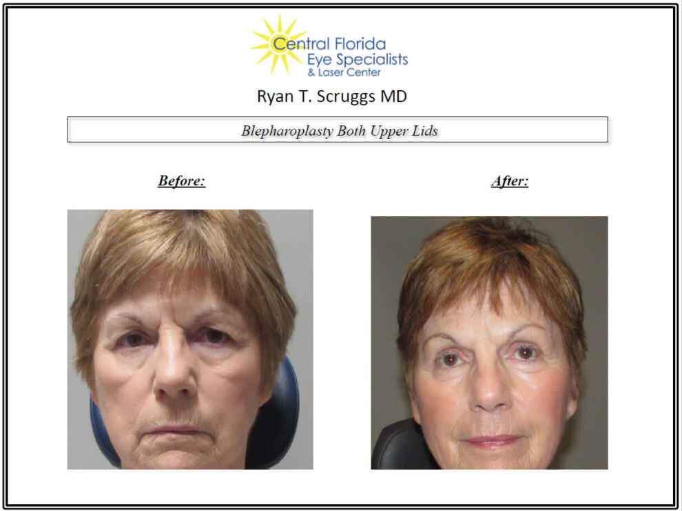 Blepharoplasty Upper Lids Before and After