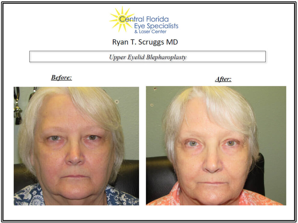 Upper Eyelid Blepharoplasty Before and After Gallery